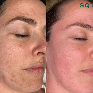 Microneedling